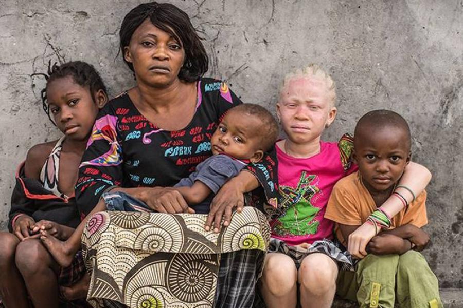 People affected by albinism are often visually impaired and need special protection against the sun. They often develop skin cancer and suffer from social stigmatization, according to UNICEF.
