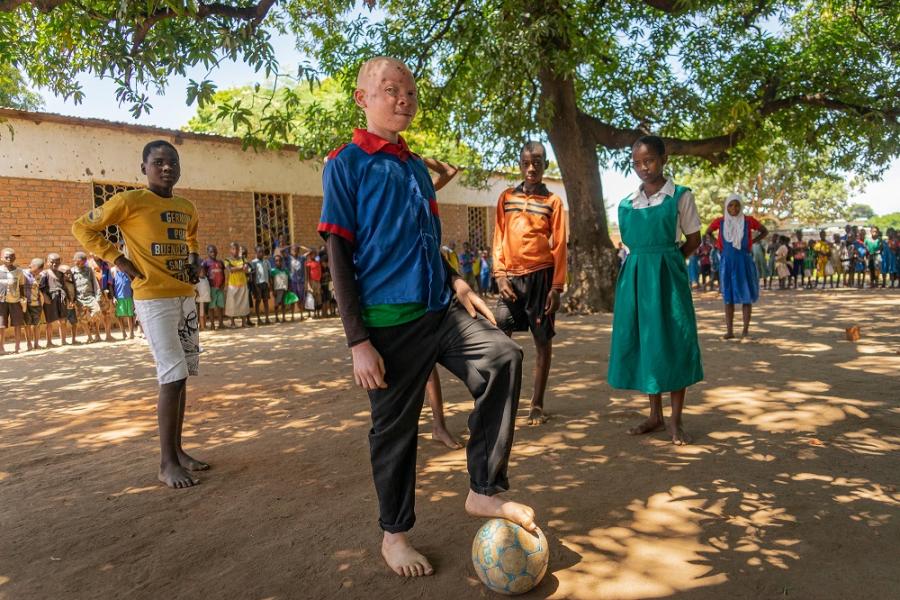 Chinsisi Jafali, a 14-year-old with albinism in Malawi